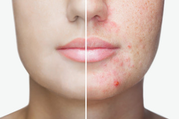 Acne and Acne Scars 